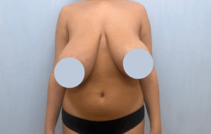 foto mastoplastica riduttiva