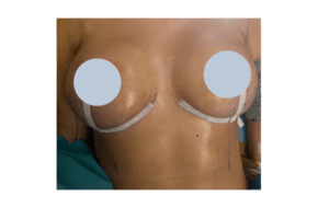 foto mastoplastica riduttiva a catania