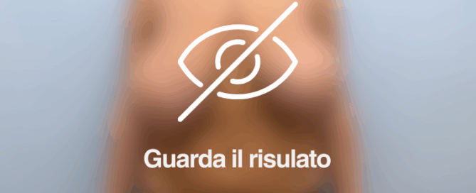 foto prima dopo mastoplastica riduttiva youplast chirurgo plastico Catania