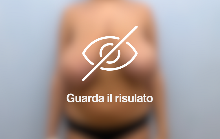 foto prima dopo mastoplastica riduttiva youplast chirurgo plastico Catania
