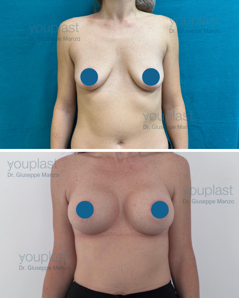 foto prima dopo mastopessi con protesi